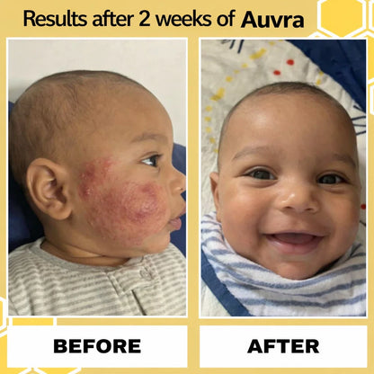Auvra™ Honey Eczema Cream